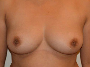 Inverted Nipple Repair Case 14552 Before Photo Inverted Nipple Repair
