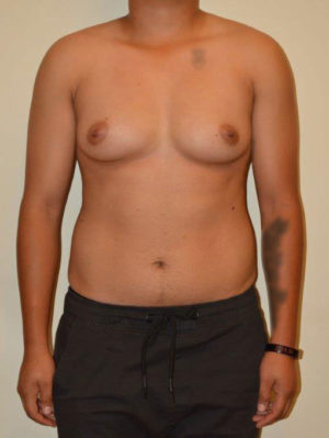 Female to Male Case 14555 Before Photo Female to Male