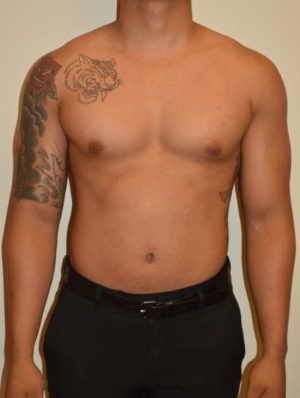 Gynecomastia Case 14596 Before Photo Gynecomastia