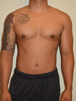 Gynecomastia Case 14596 After Photo Gynecomastia
