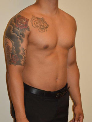 Gynecomastia Case 14596 Before Photo Gynecomastia