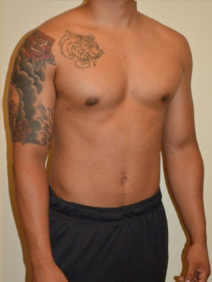 Gynecomastia Case 14596 After Photo Gynecomastia