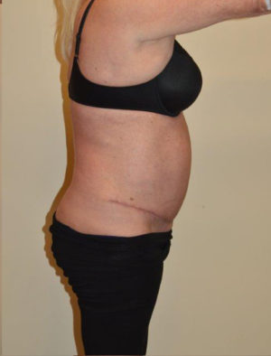 Tummy Tuck Case 14595 After Photo Tummy Tuck