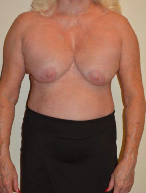 Breast Revision Case 14563 Before Photo Breast Revision
