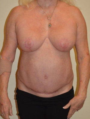 Breast Revision Case 14563 After Photo Breast Revision