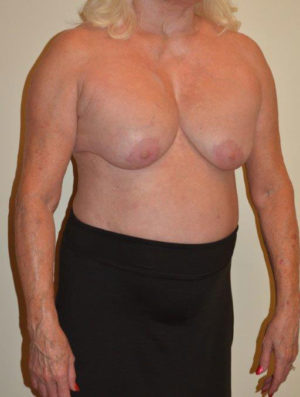 Breast Revision Case 14563 Before Photo Breast Revision