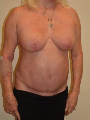 Breast Revision Case 14563 After Photo Breast Revision