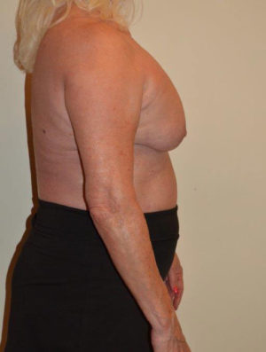 Breast Revision Case 14563 Before Photo Breast Revision