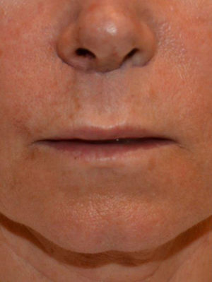 Lip Augmentation Case 14570 Before Photo Lip Augmentation