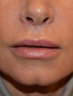 Lip Augmentation