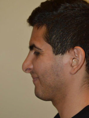 Nose Surgery Case 14580 Before Photo Nose Surgery