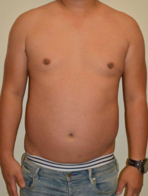 Male Pectoral Implants Case 14587 Before Photo Male Pectoral Implants