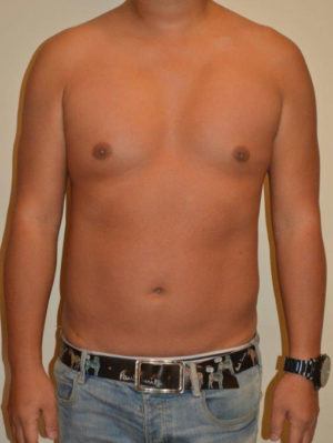 Male Pectoral Implants Case 14587 After Photo Male Pectoral Implants