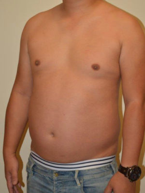 Male Pectoral Implants Case 14587 Before Photo Male Pectoral Implants