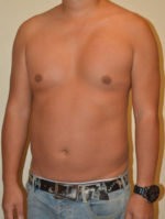 Male Pectoral Implants