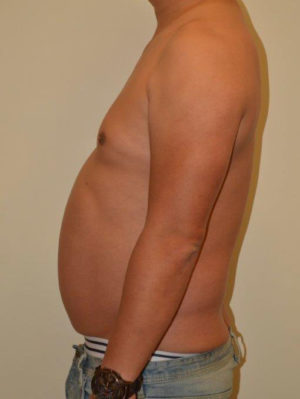 Male Pectoral Implants Case 14587 Before Photo Male Pectoral Implants