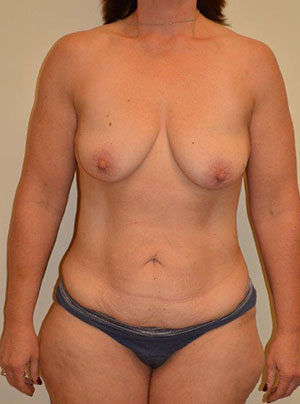 Breast Augmentation with Lift Case 14613 Before Photo Breast Augmentation with Lift