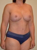 Breast Augmentation with Lift