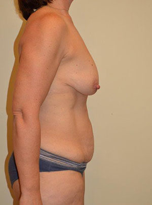 Breast Augmentation with Lift Case 14613 Before Photo Breast Augmentation with Lift
