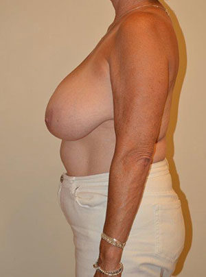 Breast Reduction Case 14620 Before Photo Breast Reduction