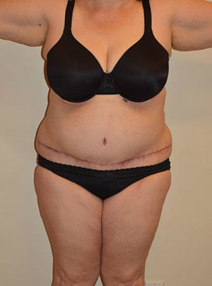 Tummy Tuck Case 14632 After Photo Tummy Tuck