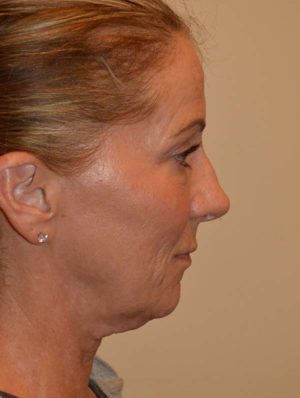 Facelift and Necklift