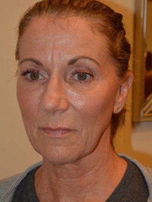 Facelift and Necklift