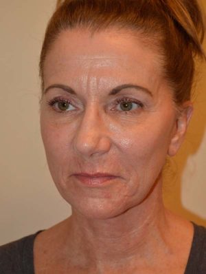 Facelift and Necklift