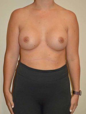 Breast Augmentation