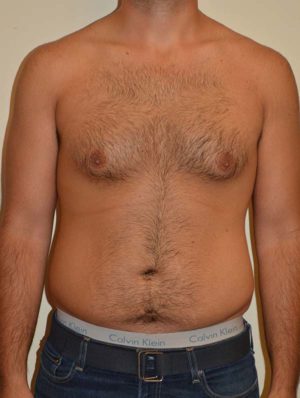 Gynecomastia Case 14714 Before Photo Gynecomastia