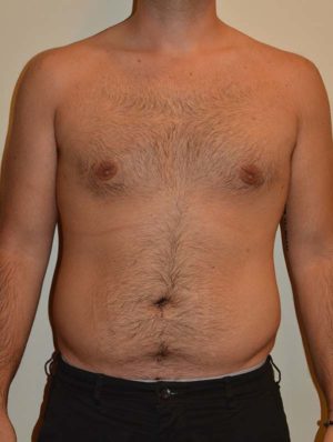 Gynecomastia Case 14714 After Photo Gynecomastia
