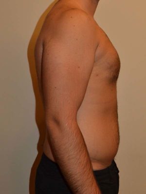 Gynecomastia Case 14714 After Photo Gynecomastia