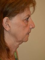 Facelift and Necklift