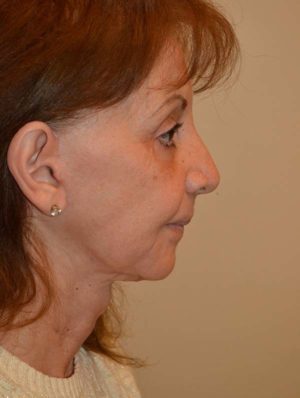 Facelift and Necklift