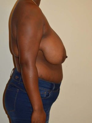 Breast Reduction Case 14718 Before Photo Breast Reduction