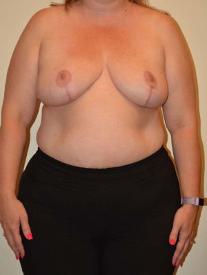 Breast Reduction