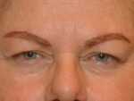 Eyelid Surgery