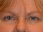 Eyelid Surgery