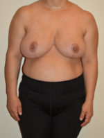 Breast Reduction