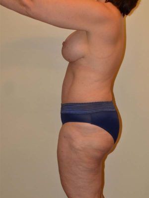 Tummy Tuck Case 14804 After Photo Tummy Tuck