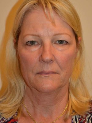 Facelift and Necklift Case 14805 Before Photo Facelift and Necklift