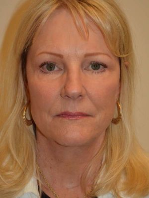 Facelift and Necklift Case 14805 After Photo Facelift and Necklift