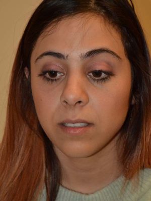 Nose Surgery Case 14808 After Photo Nose Surgery