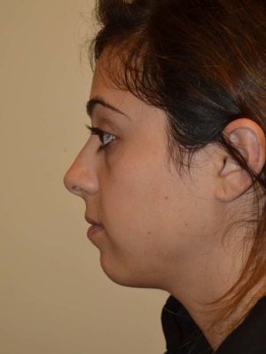 Nose Surgery Case 14808 Before Photo Nose Surgery