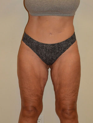 Inner Thigh Lift Case 14928 Before Photo Inner Thigh Lift