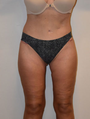 Inner Thigh Lift Case 14928 After Photo Inner Thigh Lift