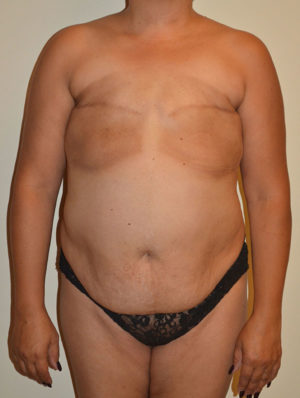 Breast Reconstruction