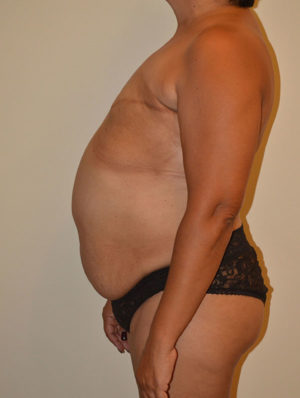 Breast Reconstruction Case 14929 Before Photo Breast Reconstruction