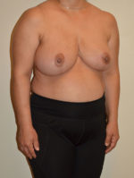 Breast Reduction