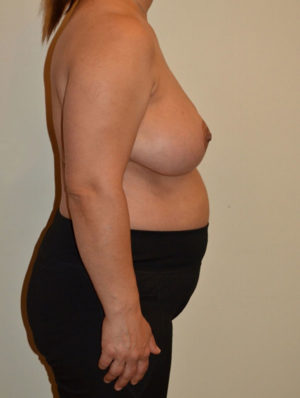 Breast Reduction Case 14930 After Photo Breast Reduction